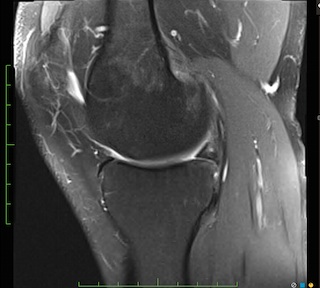 Figure 2 for case Meniscal ossicle